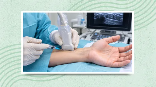 Minimally Invasive Ultrasound-Guided Treatment Offers Long-Term Relief for Carpal Tunnel Syndrome