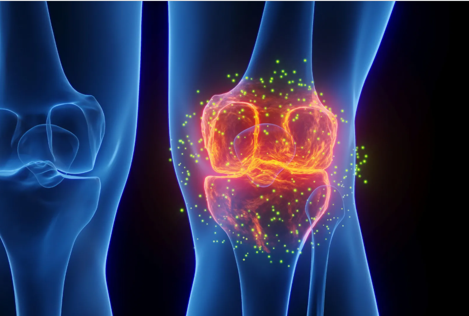 FDA-Approved Epilepsy Drug May Help Reverse Osteoarthritis Damage in Early Research
