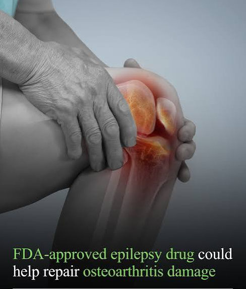 Epilepsy Medicine Lacosamide Shows Potential for Protecting Cartilage in Osteoarthritis Research