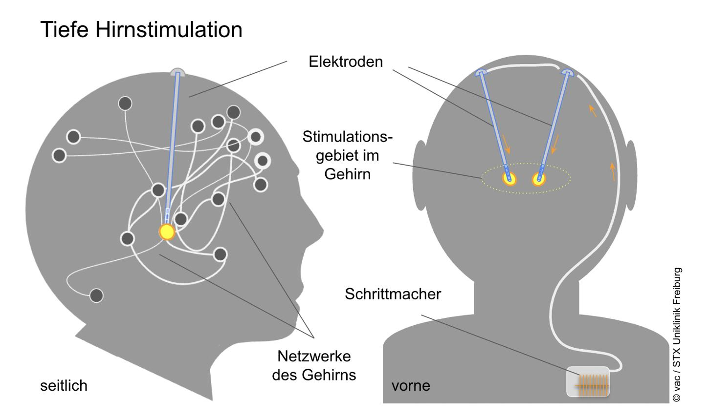 Targeting Specific Brain Circuits May Improve Treatment Outcomes for Severe Depression
