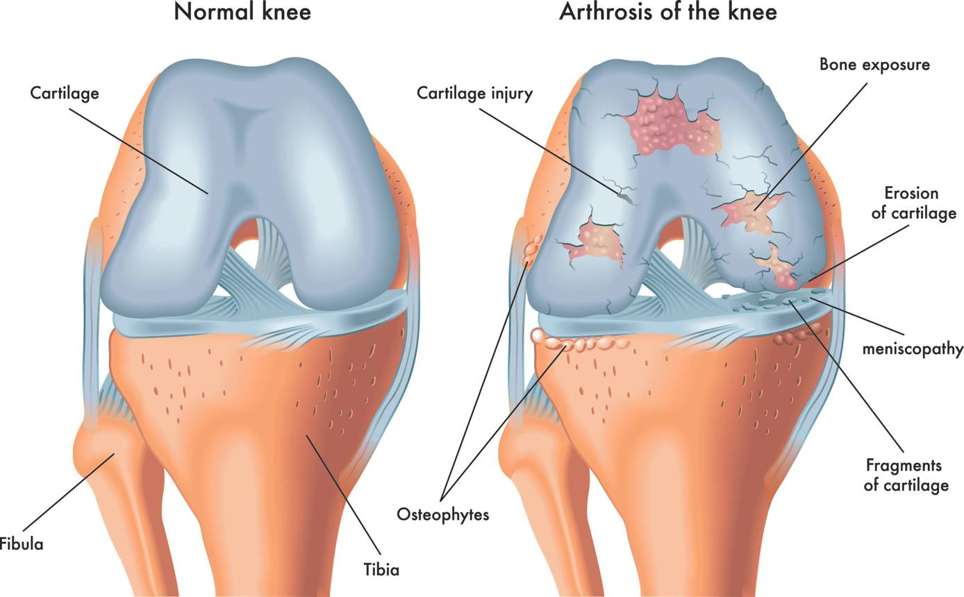 Investigational Knee Injection Targets Cartilage Loss in Osteoarthritis