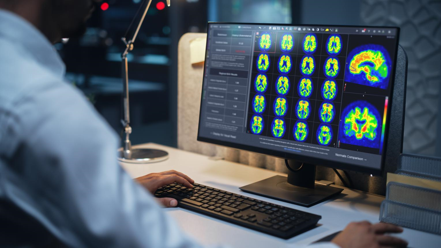 Study Finds Significant Differences in Access to New Alzheimer's Disease Treatments