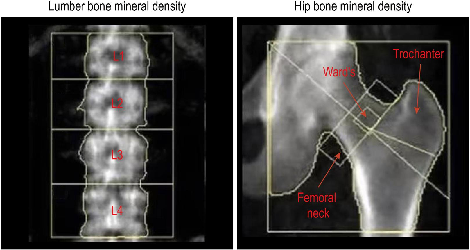 Targeting an Immune Signaling Pathway Could Offer a New Direction for Osteoporosis Research